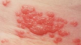 Symptoms and Prevention for Shingles  San Diego Dermatology  Dr Goldman [upl. by Nyloj]