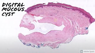 Digital Mucous Cyst vs Ganglion Cyst 5Minute Pathology Pearls [upl. by Assenahs]