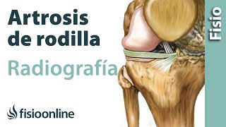 Artrosis de rodilla  Qué es y cómo se diagnostica en radiografías [upl. by Gardel]