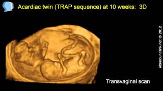 Twin studies and adoption studies  Behavior  MCAT  Khan Academy [upl. by Nivrek]