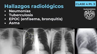 043  Neumonía TB EPOC Enfisema Bronquitis Bronquiectasias Asma [upl. by Ezarras]