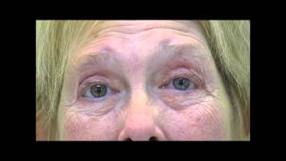 VIMPAT Blepharospasm Hemifacial Spasm Testimonial 2 [upl. by Nellir]