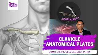 Clavicle Anatomical Plates Fixation Procedure [upl. by Donny]