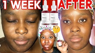 The Ordinary AHA 30 BHA 2 Peeling solution Before and After 1 week  How to Use amp How to Layer [upl. by Edmon614]