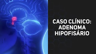 Caso Clínico Adenoma hipofisário [upl. by Sidnac]