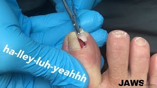 REMOVING A LARGE INGROWN TOENAIL [upl. by Cristabel236]