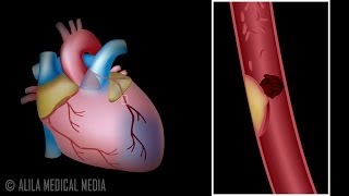 Restoring circulation Treating critical limb ischaemia [upl. by Llertram363]