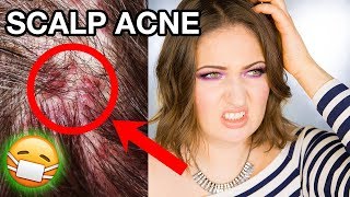 SCALP ACNE amp ITCHY DANDRUFF  How To Get Rid of It Completely [upl. by Comyns]