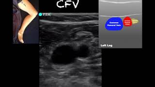 Deep Venous Thrombosis DVT  Causes Symptoms Signs Diagnosis and Treatment  Pulmonology [upl. by Romalda764]