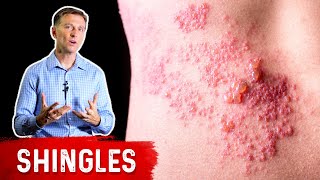 shingles symptoms natural treatment [upl. by Ardme]