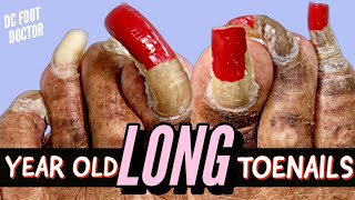 Year Old Long Toenails Trimming Extremely Long Toenails [upl. by Bamford528]