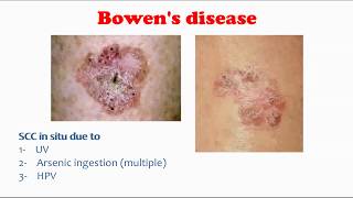 Bowens disease [upl. by Harriet439]