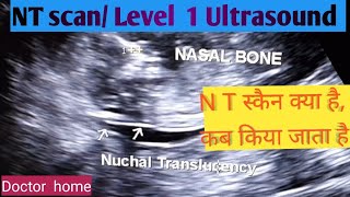 NT scan Level 1 ultrasound Pregnancy ultrasound Doctor home [upl. by Joses90]