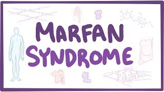 What activities can people with Marfan syndrome do [upl. by Kathe203]