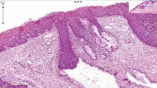 Inverted Papilloma of Nose  ENT [upl. by Noella]