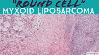 quotRound cellquot High Grade Myxoid Liposarcoma [upl. by Horvitz]