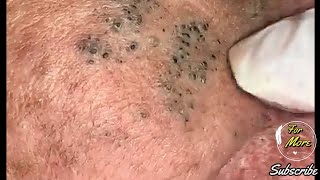 Dr Pop  Deep Blackheads in old Skin removing amp treatment 2020 Part 4 HD [upl. by Winstonn286]