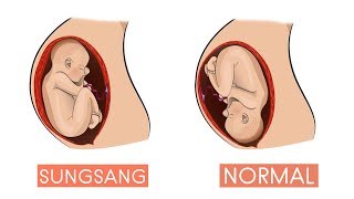 Posisi Bayi Sungsang  Begini Cara Mengubah Posisi Bayi Sungsang Menjadi Normal [upl. by Adilen]