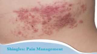 Shingles Explained by Top Pain Doctor in Las Vegas Nevada [upl. by Ib563]