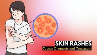 Skin Rash Causes Signs and Symptoms Diagnosis and Treatment [upl. by Enirrok68]