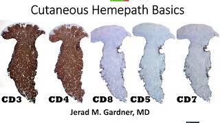 Cutaneous Hemepath 101 Skin Lymphoma Leukemia amp Histiocytic Infiltrate Basics Hematopathology [upl. by Latvina]