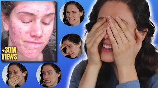 Esthetician Reacts To Horrific Cystic Acne Video That Went Viral 10 Years Ago Today [upl. by Neitsabes]