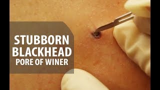 Stubborn Blackhead Removal  Dr Derm [upl. by Nerin]