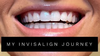 MY INVISALIGN JOURNEY  Haleigh Markar [upl. by Danby841]