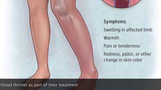 How To Deep Vein Thrombosis Ultrasound Exam 3D Video [upl. by Verda]