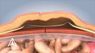 Ventral Hernia Repair  3D Medical Animation [upl. by Eirehc925]