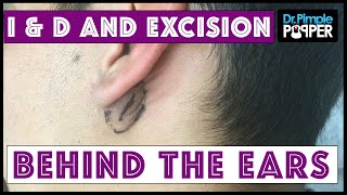 Inflamed and NonInflamed Cyst Removals Behind Ears [upl. by Erbua]