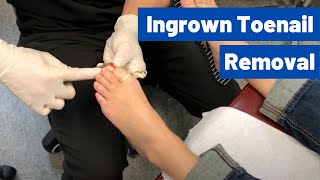 Ingrown Toenail Removal Surgery Video  Permanent Cosmetic Procedure [upl. by Os735]