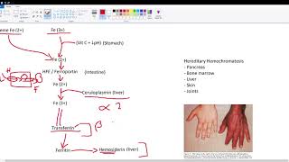 Iron Fe Metabolism  Hereditary Hemochromatosis [upl. by Nykal837]