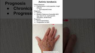 Actinic keratosis [upl. by Ruprecht]