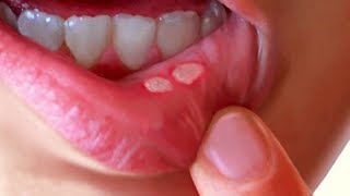 How To Remove A Mouth Ulcer Fast  Home Remedies [upl. by Nahtanohj]