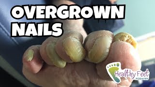 Overgrown Toe Nails [upl. by Libb]