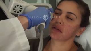 Syneron Profound Microneedling with Radiofrequency  Skin Facial Tightening and Lifting [upl. by Reine]