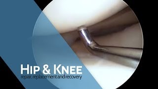 The Procedure  Arthroscopy [upl. by Alliuqa]