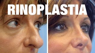 Rinoplastia Antes y Después  Tratamiento de Ana Isabel [upl. by Gomar]