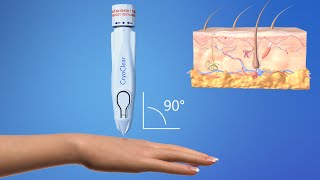 CryoConcepts  CryoClear Device  3D Medical Animation [upl. by Einahpetse]