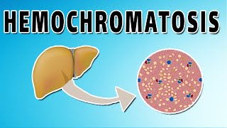 Hemochromatosis [upl. by James]