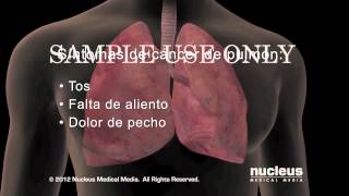 Síntomas del cáncer de pulmón [upl. by Relyt]